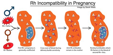 Rh Incompatibility